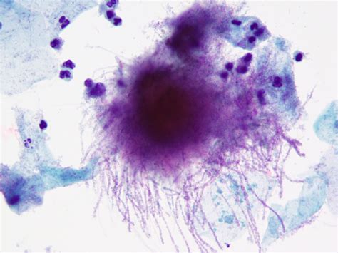 Actinomyces treatment antibiotics