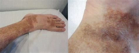 ACD A-Z of Skin - Pigmented Purpuric Dermatosis