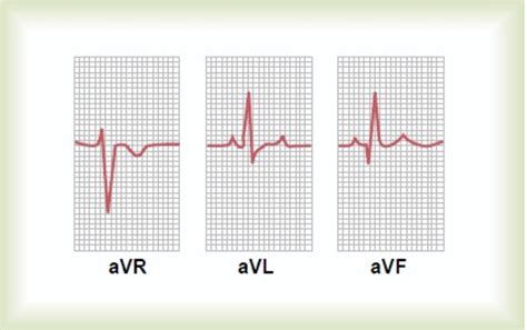 How to read a normal ECG(Electrocardiogram)? - HubPages