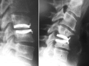 Very Late Complications of Cervical Arthroplasty - Neurosurgery Blog