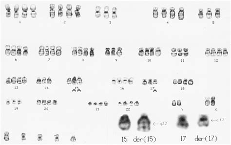 Tetraploid karyotype with t(15;17) (shown by arrows). | Download Scientific Diagram