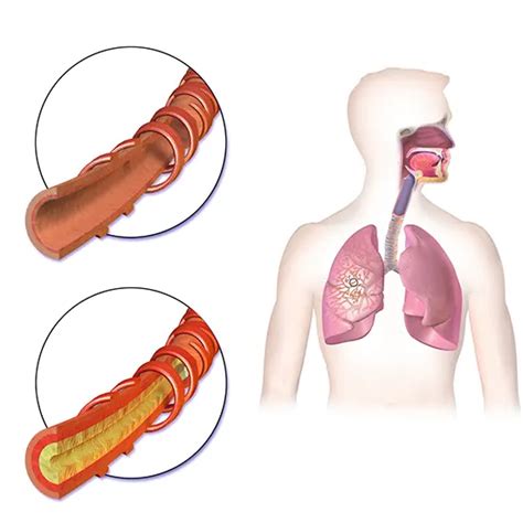 Hemoptysis: Causes, Diagnosis, Symptoms & Treatment