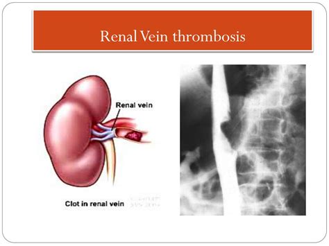 PPT - Acute Kidney Injury (Acute Renal Failure ) PowerPoint ...