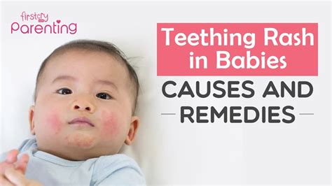 Teething Rash (Drool Rash) in Babies - Causes, Remedies & Prevention ...