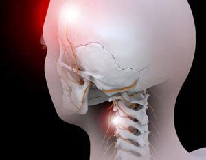 Cervicogenic Headaches | Orthopedic Blog | OrthoCarolina