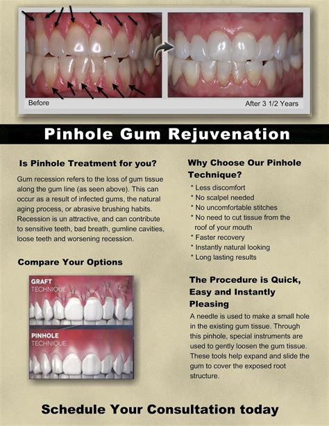 LaserDennisT: Gum Recession Surgery Revolutionized!