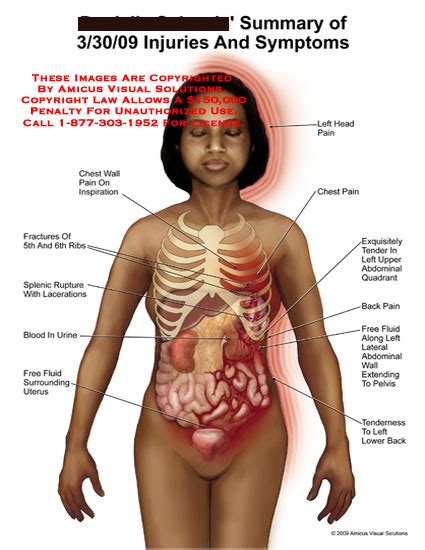 AMICUS Illustration of amicus,injury,summary,symptoms,chest,wall,pain ...