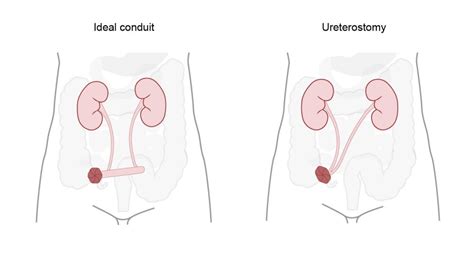 What is a Stoma? Stoma Function and Types Explained | B. Braun Australia - B. Braun