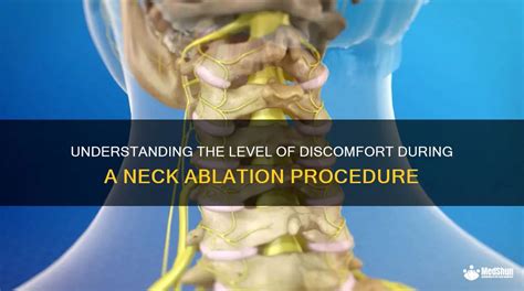 Understanding The Level Of Discomfort During A Neck Ablation Procedure ...