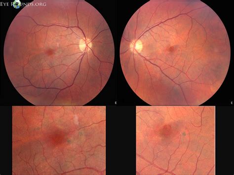 Pattern Dystrophy Associated with Myotonic Dystrophy: The University of ...