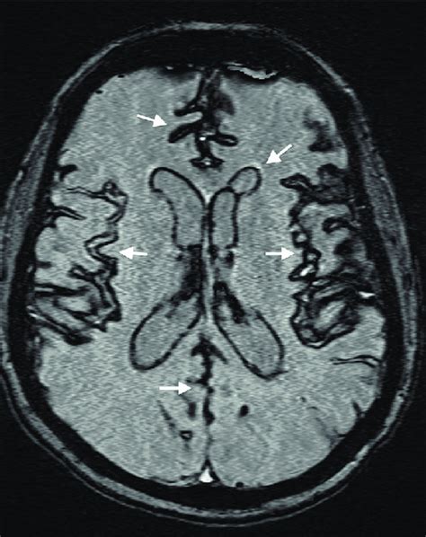 Susceptibility-weighted MRI imaging displaying hemosiderin staining... | Download Scientific Diagram