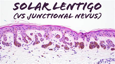 Solar Lentigo vs Junctional Nevus (plus sun burn cells & large cell ...