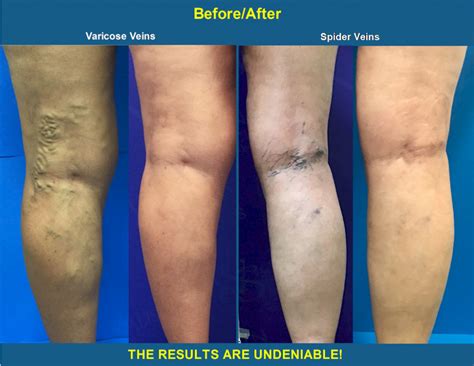 The Before and After Transformation! - Vein Specialists of the Carolinas