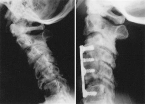 Cervical corpectomy: report of 185 cases and review of the literature ...