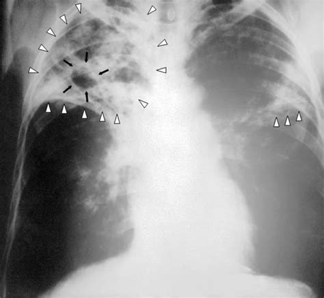 File:Tuberculosis-x-ray-1.jpg - Wikipedia