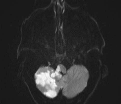 Lateral Pontine Syndrome Mri