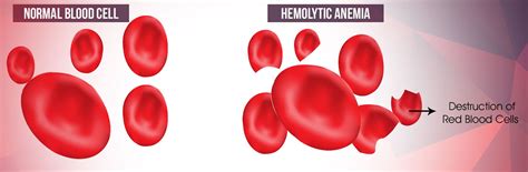 Hemolytic Anemia - Causes, Symptoms, Treatment