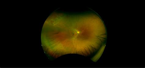 California - Peripheral Retinal Tear, RG