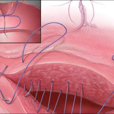 Uterine incision closure: Is it the culprit in the cesarean scar niche ...