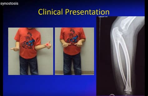 Congenital RadioUlnar Synostosis — OrthopaedicPrinciples.com