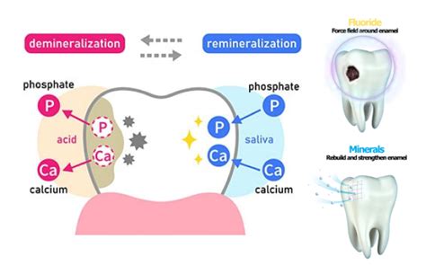 Effective Remineralization Trays | Tooth & Cavity Remineralization