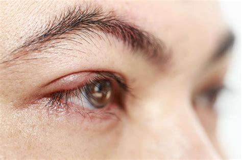 Eye Infection: 10 Eye Infection Symptoms