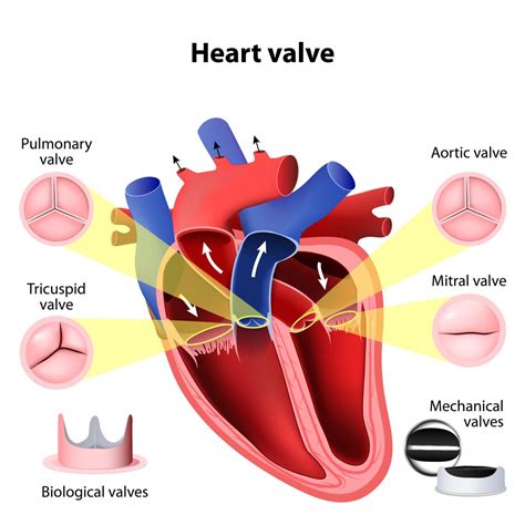 Mechanical heart valves | Heart Surgery Information