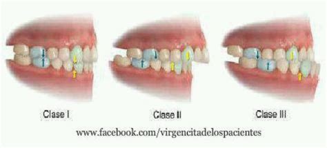 Occlusal Classes Are you studying for a Dental Assisting or DANB exam? Affordab... - Megan ...