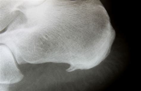 Heel Spur Surgery: Preparation, Recovery, Long-Term Care