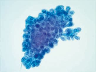 Urine Cytology | Basicmedical Key