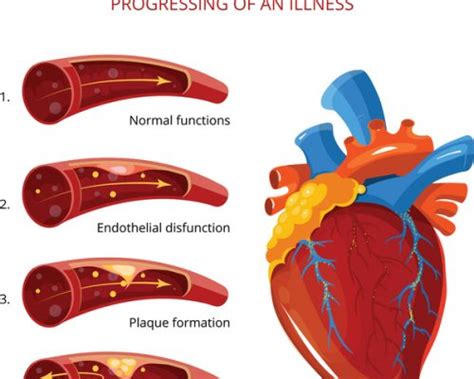 Atherosclerosis Treatment: Exercise, Diet and Remedies