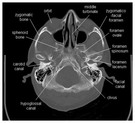 Radiographic Anatomy of the Orbit and Visual Pathways | Radiology Key