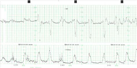 Interpreting cardiotocograph tracings | The BMJ