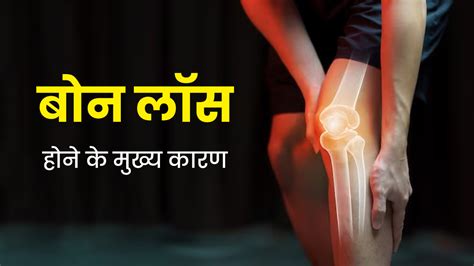 बोन लॉस क्यों होता है? एक्सपर्ट से जानें इसके मुख्य कारण | main causes of bone loss tells by ...