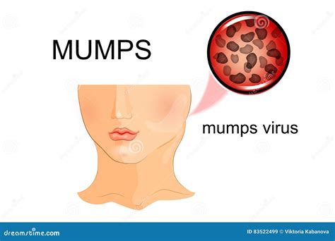 Infographic Of Mumps Cartoon Vector | CartoonDealer.com #148915341