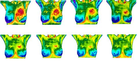 Early Detection Through Breast Thermography – DYLN