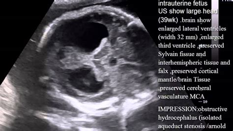 CASE 134-fetal obstructive hydrocephalus - YouTube