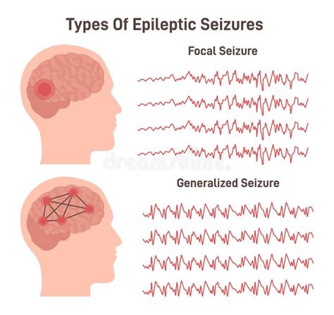 Types of Epilepsy. Generalized and Focal Seizures Stock Vector ...