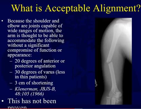 Humeral shaft fractures: Indications for Operative treatment Vs ...