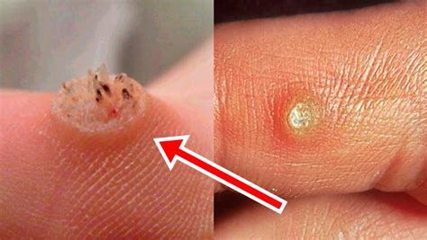 Cheapest Way To Remove Warts – Everyone Needs To Know This – Virality Facts