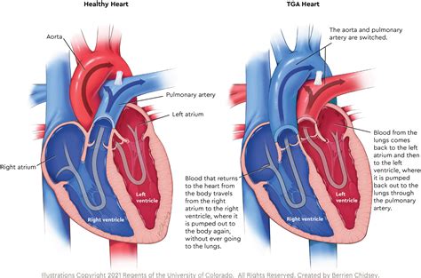 Transposition Of The Great Arteries Symptoms And Causes, 43% OFF