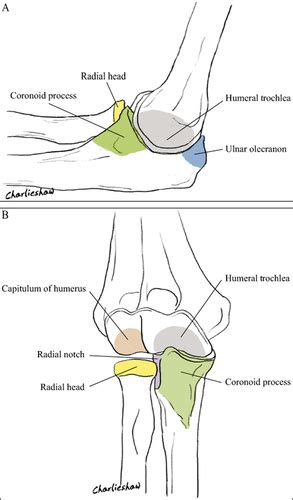 Anatomy, Definition, and Treatment of the “Terrible Triad of the Elbow” and Contemplation of the ...