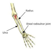 Distal Radioulnar Joint Subluxation | symptoms and treatment| Sportsinjuryclinic.net