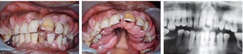 Generalised Fibrotic gingival | Download Scientific Diagram