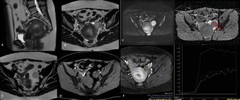 Figure 1 from A Rare Presentation of Polypoid Endometriosis of the Douglas Pouch: Case Report ...