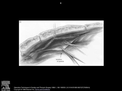 Gastroepiploic Artery Graft: Coronary Artery Bypass Graft in Patients With Diseased Ascending ...