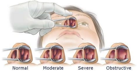 Addressing Your Deviated Septum: Houston Sinus Surgery: Ear, Nose & Throat Doctors