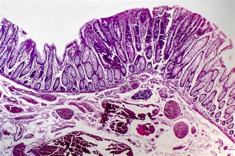 Colon Adenoma Detection Rates Enhanced with Presence of Second Observer ...