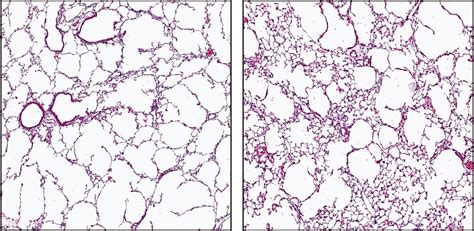 Treatment with Blood Vessel-Lining Endothelial Cells Reverses Emphysema ...