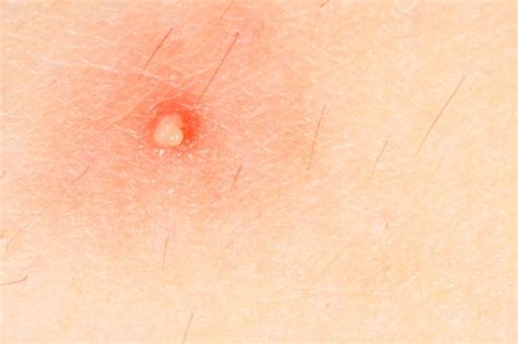 Molluscum contagiosum: Symptoms, causes, and treatment